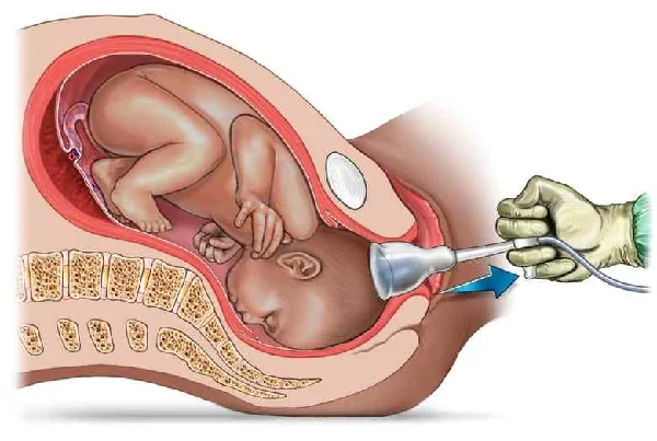 Instrumental Delivery