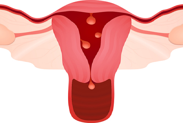 Abnormal Uterine Bleeding