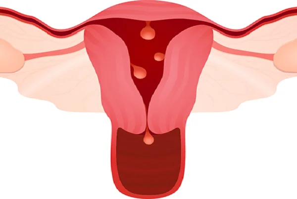 Abnormal Uterine Bleeding