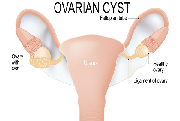 Ovarian Cyst