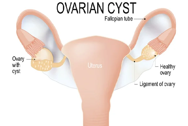 Ovarian Cyst