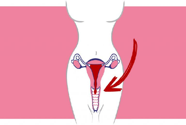 Uterine Prolapse