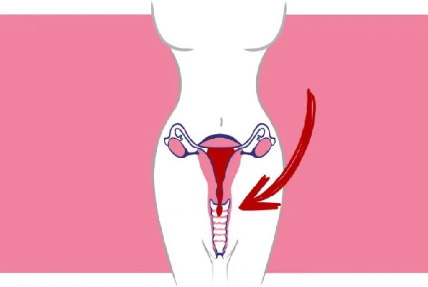 Uterine Prolapse