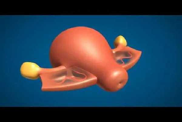Non Descent Vaginal Hysterectomy